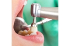 Удаление временного зуба