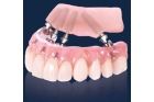 Протезирование зубов на 5 имплантах