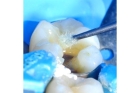 Лечение пульпита постоянного зуба (2 канала) + полная реставрация (1 посещение)
