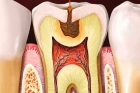 Лечение пульпита постоянного зуба (3 канала) + частичная реставрация