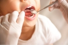Лечение пульпита постоянного зуба (4 канала) + частичная реставрация (2 посещение)