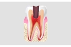 Лечение периодонтита постоянного зуба (1 канал)+ полная реставрация (1 посещение)