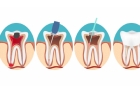 Лечение периодонтита постоянного зуба (1 канал)+ частичная реставрация (последнее посещение)