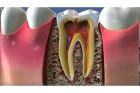 Лечение периодонтита постоянного зуба (2 канала)+ полная реставрация (1 посещение)