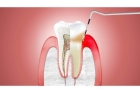 Лечение периодонтита постоянного зуба (2 канала)+ полная реставрация (2 посещение)