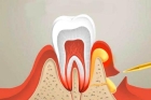 Лечение периодонтита постоянного зуба (2 канала)+ частичная реставрация (1 посещение)
