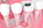 Лечение периодонтита постоянного зуба (2 канала)+ частичная реставрация (2 посещение)