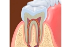 Лечение периодонтита постоянного зуба (2 канала)+ частичная реставрация (последнее посещение)