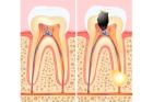Лечение периодонтита постоянного зуба (3 канала)+ полная реставрация (2 посещение)