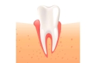 Лечение периодонтита постоянного зуба (3 канала)+ частичная реставрация (2 посещение)