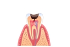 Лечение периодонтита постоянного зуба (3 канала)+ частичная реставрация (последнее посещение)