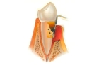 Лечение периодонтита постоянного зуба (4 канала)+ частичная реставрация (2 посещение)