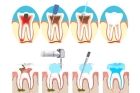 Лечение периодонтита постоянного зуба (4 канала)+ частичная реставрация (последнее посещение)