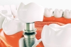 Импланты зубов в рассрочку