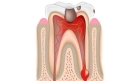 Лечение периодонтита 1 корневого зуба