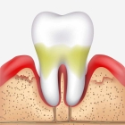 Лечение периодонтита 2 корневого зуба