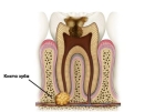 Удаление и лечение кисты зуба