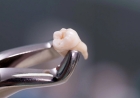 Удаление ретинированного и дистопированного зуба