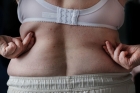 Лечение висцерального ожирения у женщин
