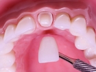 Коронки на место зуба