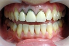 Коронки на зуб металлокерамика