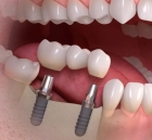 Коронки на зуб под десну