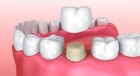 Коронки на кривые зубы