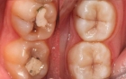 Художественная реставрация жевательной группы зубов