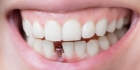 Коронки на часть зуба