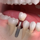 Протезирование зубов нижней челюсти 
