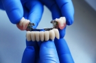 Мостовидное протезирование зубов 