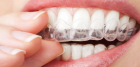 Капа для зубов стоматологическая 