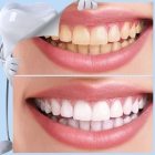 Профессиональная чистка зубов (AirFlow)