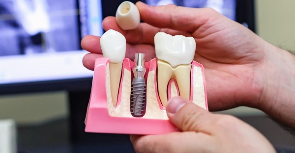 Что важно знать об имплантации зубов? Все об этапах подготовки, установки и восстановления