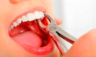 Удаление однокоренного зуба (средней сложности)