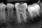 Рентгенографический снимок 1-го зуба (3 и последующий)