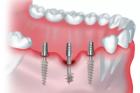 Базальная имплантация зубов под ключ