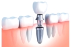 Импланты зубов верхней челюсти